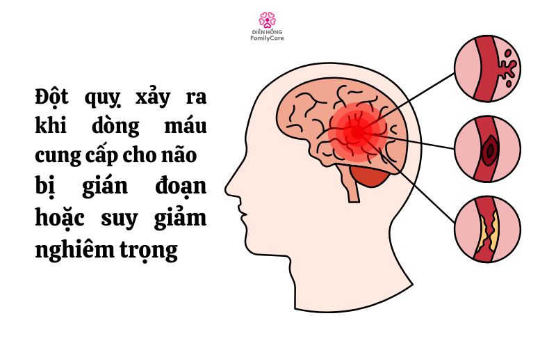 dot-quy-la-gi-nguyen-nhan-va-cach-khac-phuc