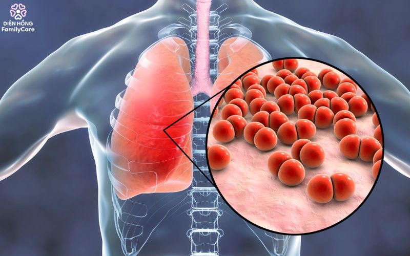 viem-phoi-o-nguoi-gia-mua-he-do-suy-giam-mien-dich