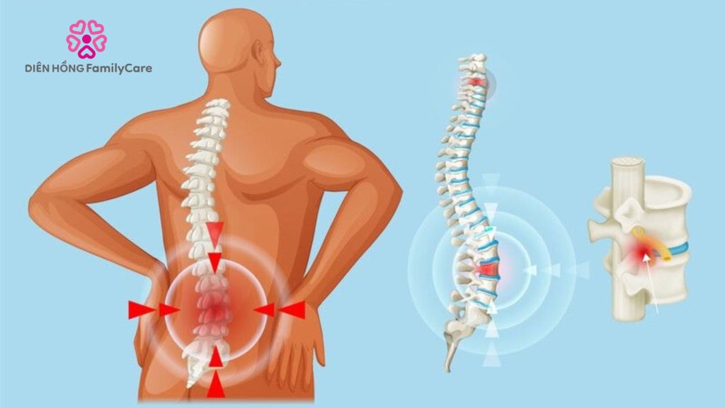 Thoát vị đĩa đệm cần được chữa đúng cách
