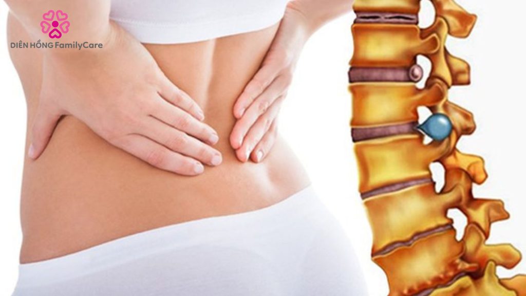 Thoát vị đĩa đệm cần làm gì để giảm đau hiệu quả