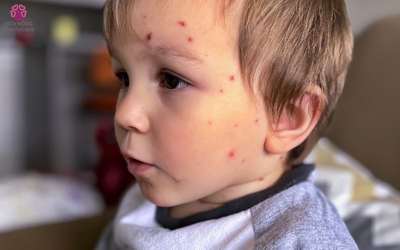 benh-thuy-dau-o-tre-nho