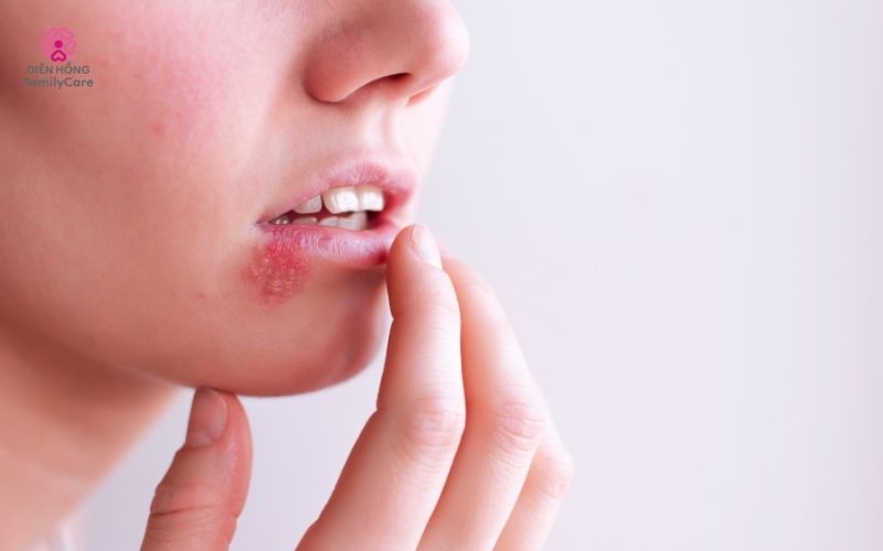 herpes-lay-qua-nu-hon