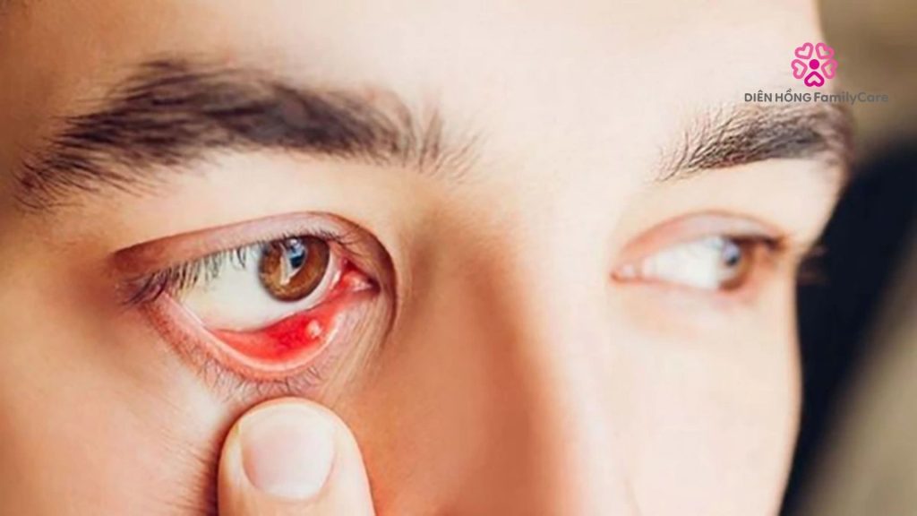 Biến chứng võng mạc của bệnh tiểu đường