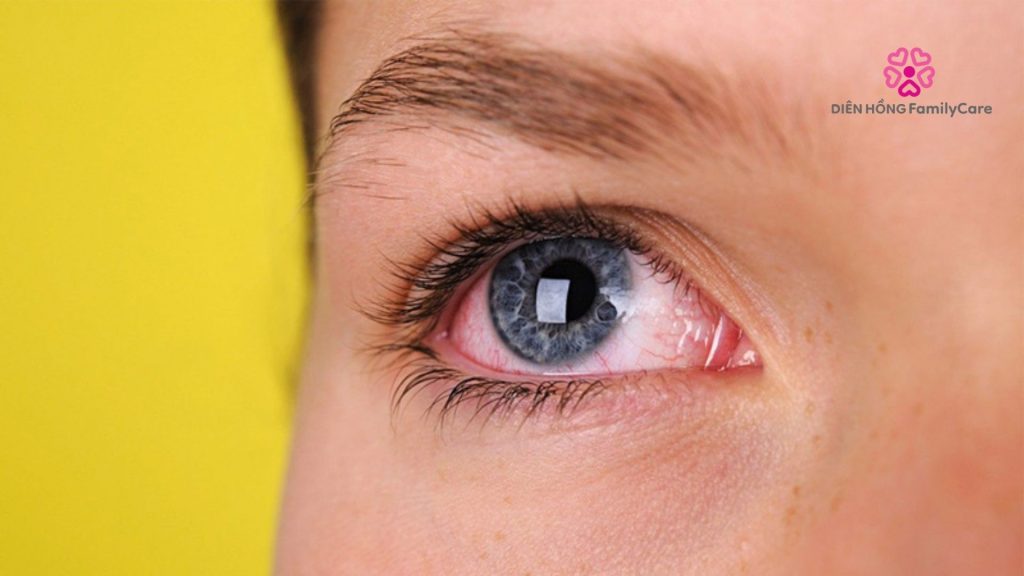 Dấu hiệu gây biến chứng tiểu đường ở mắt