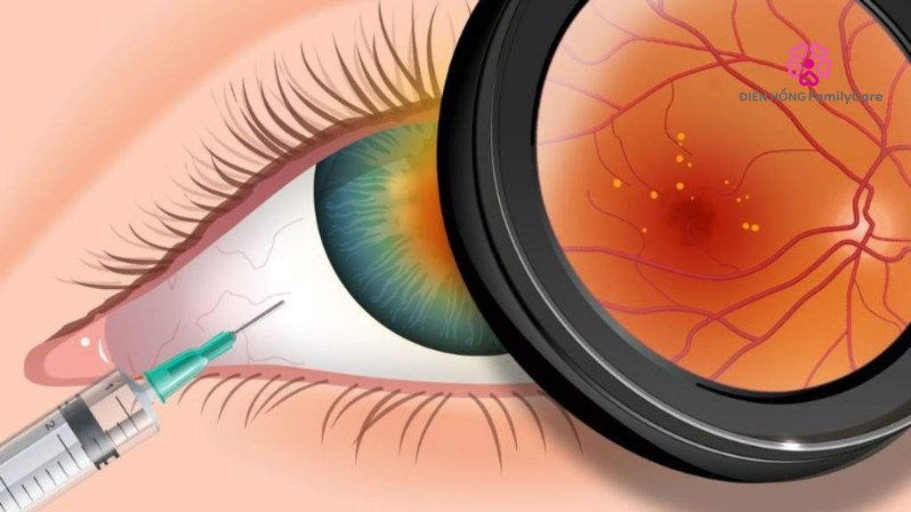 Thời gian gây ra các biến chứng tiểu đường