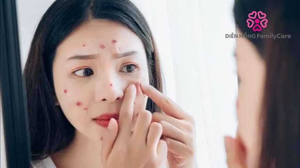 Hạn chế chăm sóc da mụn thâm tại nhà