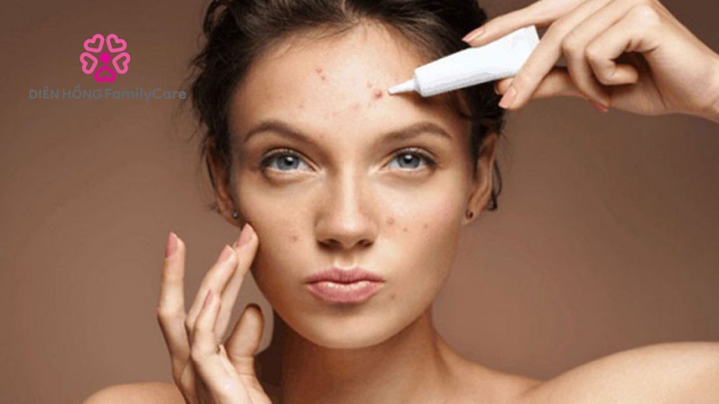 Cơ địa ảnh hưởng tới da bị mụn thâm 