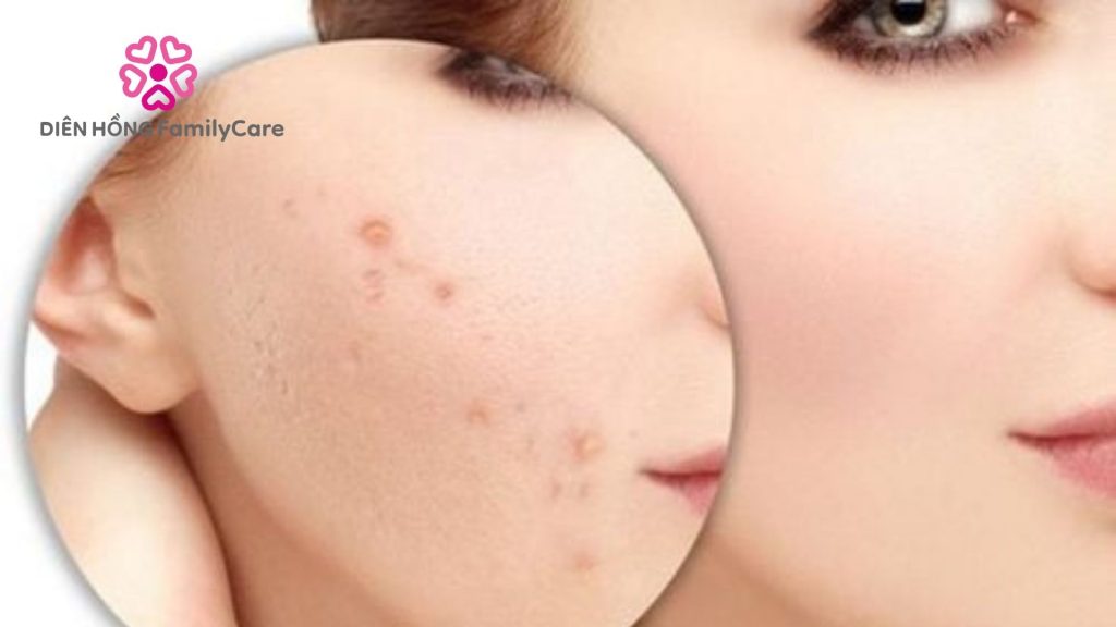 Vết mụn thâm có tự mờ không ?