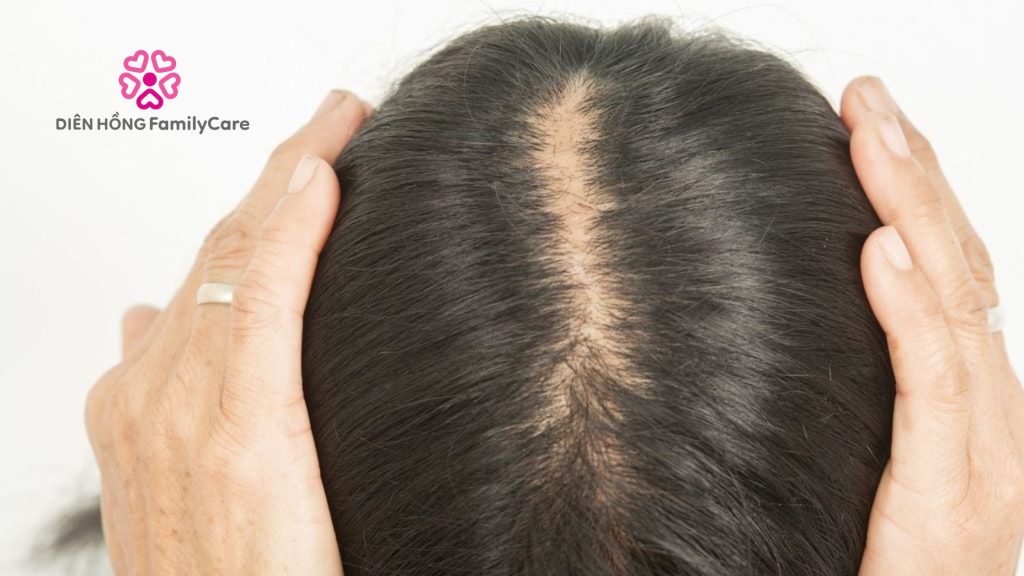 Lưu ý để chống bị rụng tóc