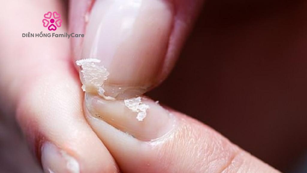 Thiếu vitamin ở móng tay