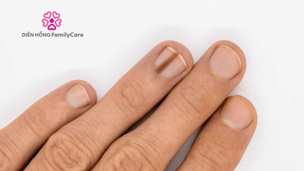 Móng tay bị sọc đen