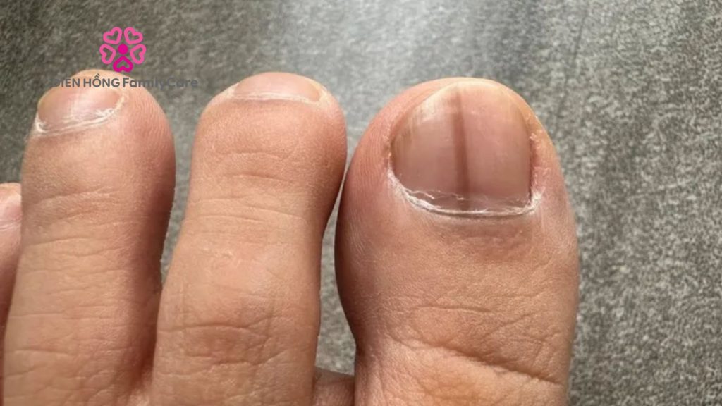 móng tay bị sọc