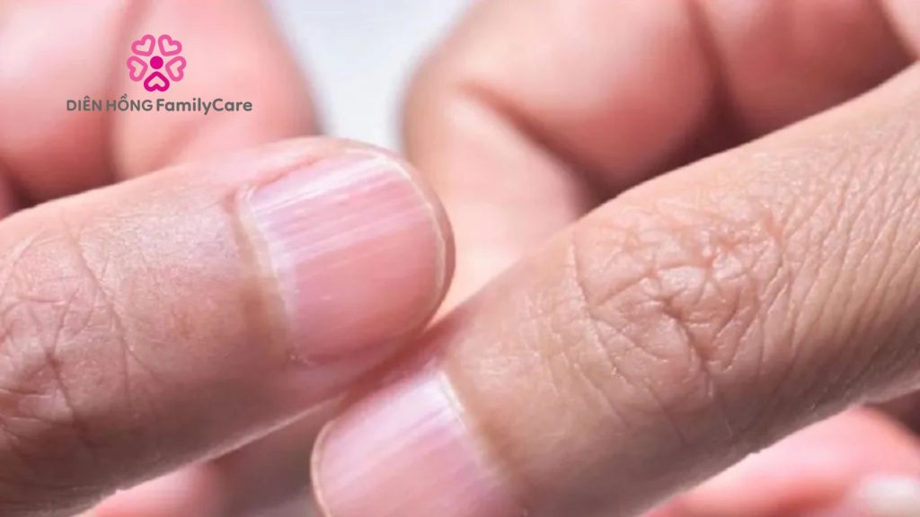 móng tay bị bệnh
