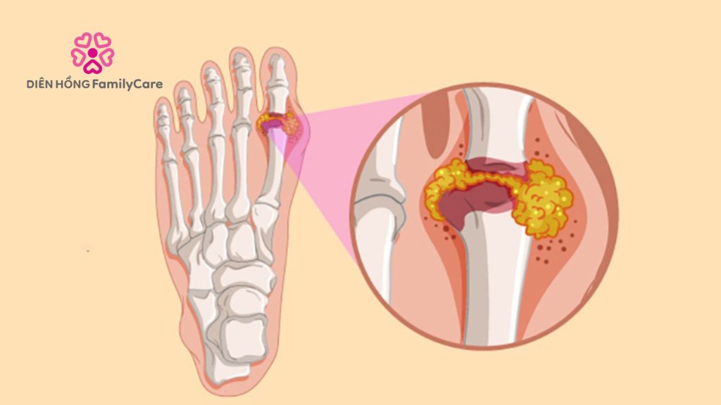 Biến chứng của bệnh gout là gì 