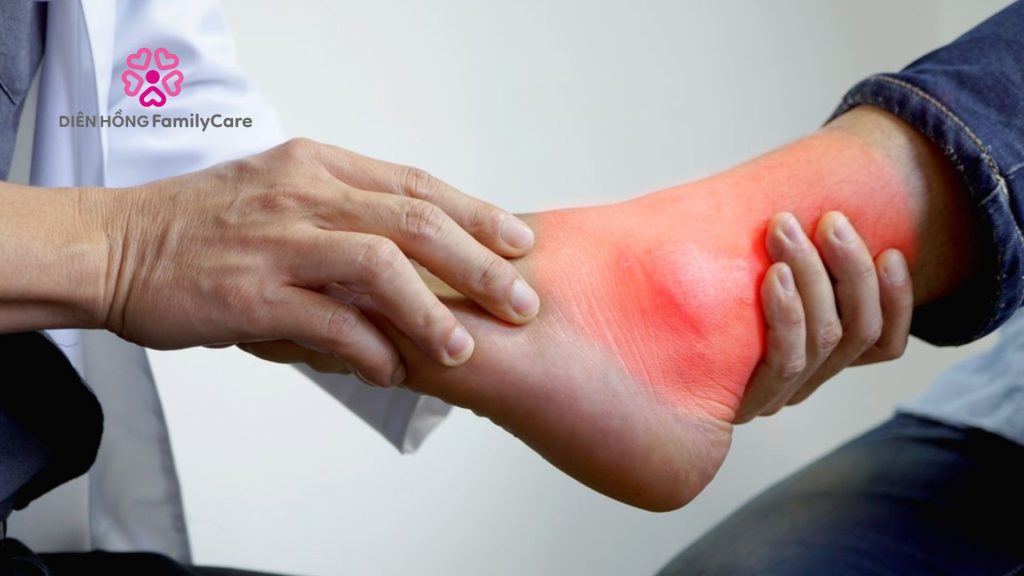 Khái niệm của bệnh gout