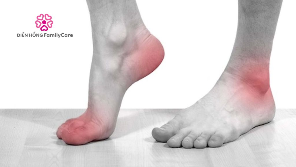 Nguyên nhân gây bệnh gout