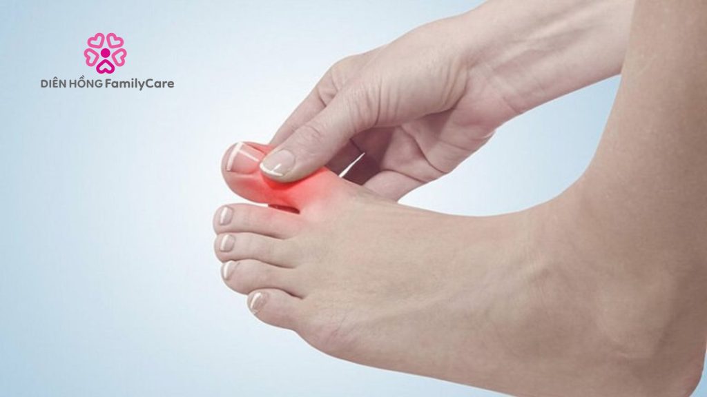 Cách giảm đau gout tại nhà