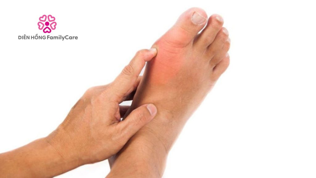 Chế độ sinh hoạt cho người bị gout