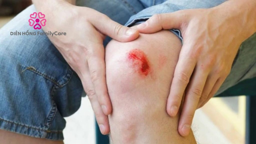 Không tự mài vết thương hở