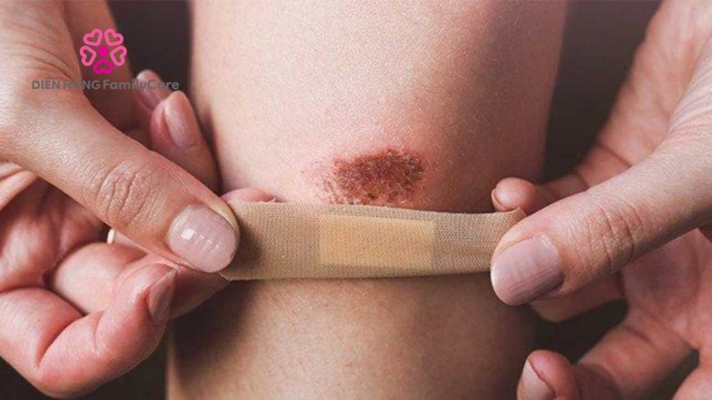 Che phủ vết thương hở bằng gạc