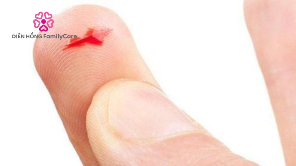 Làm thế nào để vết thương hở không để lại sẹo