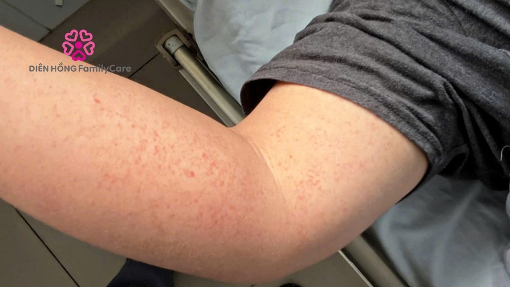 Hiểu lầm về bệnh sốt xuất huyết phổ biến