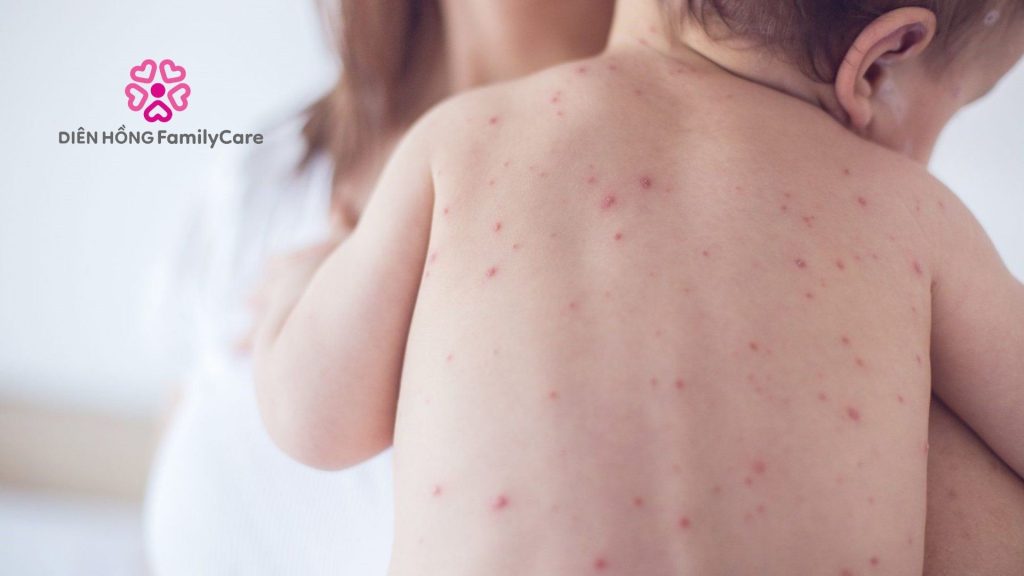 Hiểu nhầm về bệnh sốt xuất huyết ở trẻ em