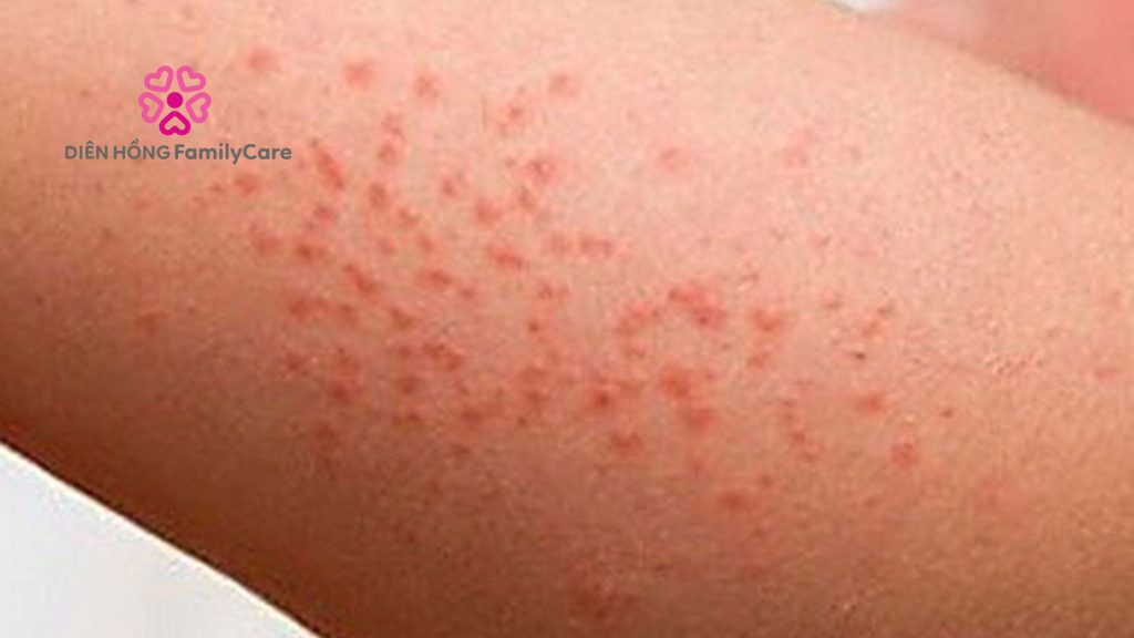 Bệnh sốt xuất huyết tự dùng thuốc